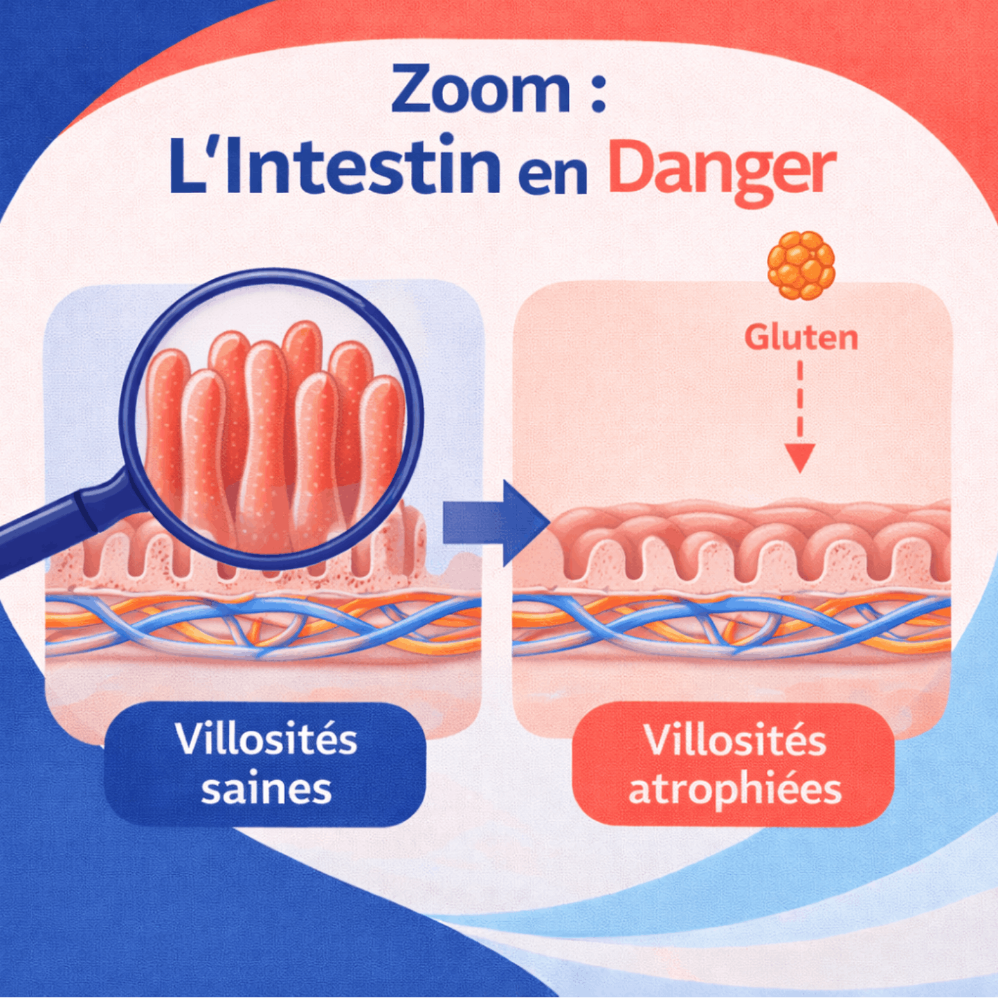 Illustration montrant l’impact du gluten sur les villosités intestinales dans la maladie cœliaque.